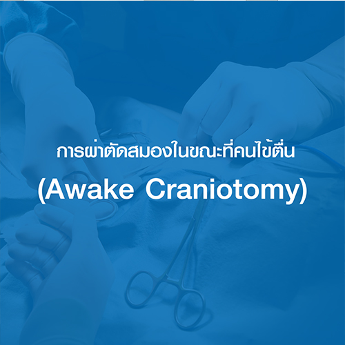 การผ่าตัดสมองในขณะที่คนไข้ตื่น (Awake Craniotomy)