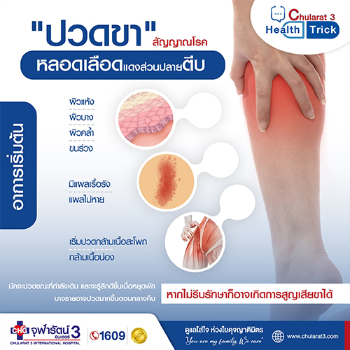 ปวดขา สัญญาณโรคหลอดเลือดแดงส่วนปลายตีบ